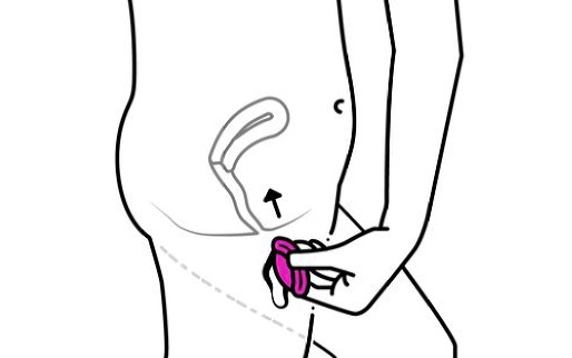 Comment positionner l'éponge contraceptive ?