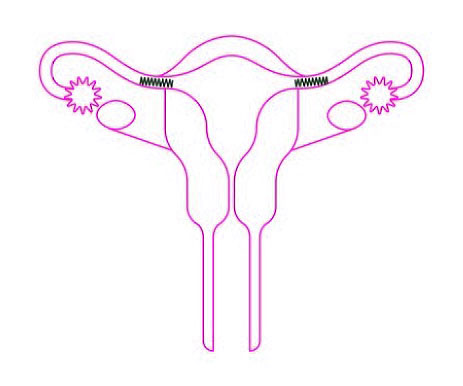 Stérilisation par ligature des trompes Essure