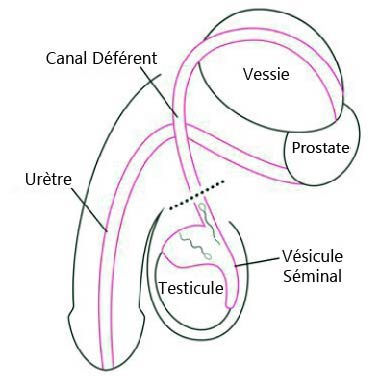 La vasectomie 